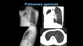 Pulmonary Agenesis  Definition Causes Symptoms Types Unilateral Bilateral [upl. by Lekar156]