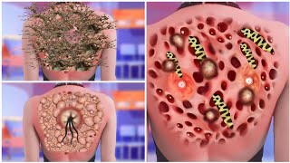 ASMR Treatment of Ticks amp Maggots Infection From Back Neck Severely Injured Animation Papon ASMR [upl. by Jarred]