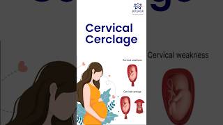 ಗರ್ಭಪಾತಕ್ಕೆ ಗರ್ಭಕೊರಳಿನ ಹೊಲಿಗೆ ರಾಮಬಾಣವೇIs Cervical Cerclage Panacea for Abortions [upl. by Galasyn]