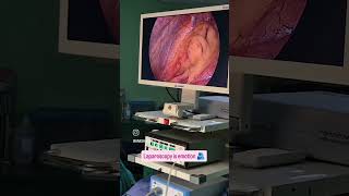 laparoscopy appendectomy [upl. by Fisa]