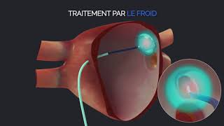 MEDUVIP  Teaser Vidéos Médicales Pédagogiques  Ablation de FA [upl. by Natsuj]