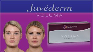 Cheek Filler Juvederm Voluma With Before and Afters [upl. by Fernandina179]