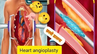 Heart 🫀में छल्ले डालना।।heart angioplasty surgery animation angioplastymbbsdoctormedical [upl. by Innek]