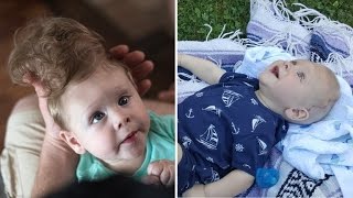 Baby Born with Brain Outside of Skull Gets LifeChanging Surgery [upl. by Rosenquist]