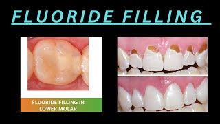 FLUORIDE FILLING MATERIALS  WHICH FLUORIDE FILLING IS BEST FOR YOUR [upl. by Lednew325]