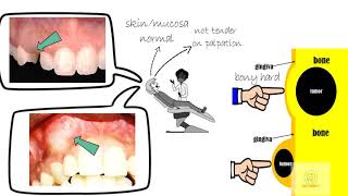 Adenomatoid odontogenic tumor [upl. by Immas197]