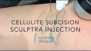 Cellulite Subcision Sculptra Injection done with Blunt Cannulas by Dr Steven F Weiner [upl. by Leirraj925]