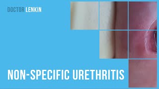 😟 Nonspecific urethritis [upl. by Babita746]