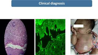 Epidermolysis Bullosa  Spot Diagnosis  9  Pediatrics [upl. by Nylemaj]