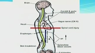 Autonomic Dysreflexia [upl. by Nnylf]