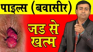 पाइल्स करे जड़ से ख़त्म piles cure by homeopathy I Piles cause symptoms treatment hindi piles [upl. by Kahaleel]