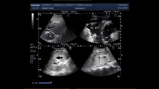 Ultrasound Video showing Bilateral renal parenchymal disease pleural effusion and ascites [upl. by Mcguire]