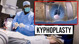 Kyphoplasty  Outpatient  Same Day Procedure for Vertebral Compression Fractures [upl. by Yelekalb]