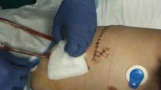 Rideys chest tube removal [upl. by Martica763]