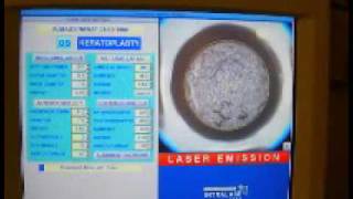 Myoring implantation after Intralase pocket creation [upl. by Ecirtnahc]