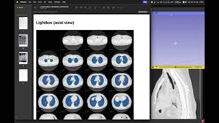 Segmentação e Análise do Parênquima pulmonar no 3D Slicer [upl. by Papert]