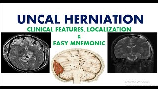 Uncal Herniation l Brain Herniations l Easy Mnemonic l Simple Explanation [upl. by Hillegass665]