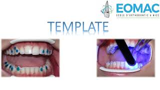 Template Invisalign [upl. by Llennyl]