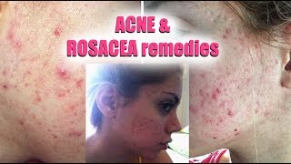 HOW TO GET RID OF ACNE AND ROSACEA  Pershii [upl. by Angelika]