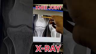 Displaced Fracture of patella x ray radiology shortvideo [upl. by Irreg390]