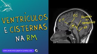 Ventrículos e Cisternas Cerebrais por RM [upl. by Baryram846]