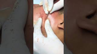 Best Pimple Popping 19beautiful blackheads sacdepspa [upl. by Naedan]