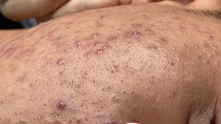 Acne Treatment Bo Nguyễn Spa  Blackheads On Tween Face 2024FULL [upl. by Jadda289]