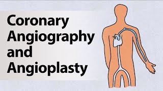 Coronary Angiography and Angioplasty [upl. by Nylarej]