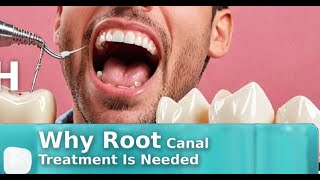 Dental Abcess Why Root Canal Treatment Is Needed [upl. by Olivero]