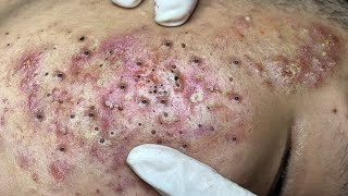 Blackhead Removal With Sac Dep Spa 523 [upl. by Mokas]