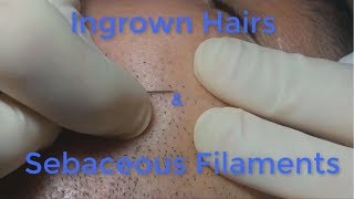 Ingrown Hairs and Sebaceous Filaments [upl. by Heinrich811]