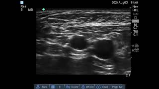 Infraclavicular block screening for vessels [upl. by Tnomel]