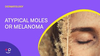 Atypical Moles or Melanoma The ABCDEs Dermatology [upl. by Ambler]