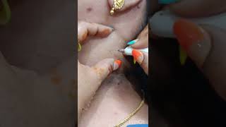 S4 Warts causes treatment and removal viralshort [upl. by Regan801]