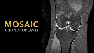 Mosaic Chondroplasty [upl. by Neerehs]