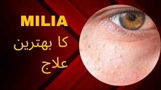 Milia Treatment and Causes  Milia Under Eye Treatment  Milia Removal Best cream Ahmedmedicalcare [upl. by Nnyluqcaj675]