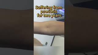 Suffering from psoriasis for two years psoriasis [upl. by Moraj]