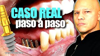 LA REALIDAD de los IMPLANTES MONOFASICOS LO QUE NUNCA MUESTRAN [upl. by Heinrike]