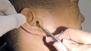 One Hard Earwax Removed form Mans Ear [upl. by Burner]