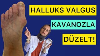 Baş Parmak Çıkıntısını KAVANOZLA Düzelt  Halluks Valgus Egzersizleri fizyoterapistmacide [upl. by Otto]