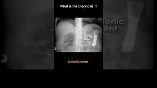 Colonic stent Abdominal Xray Abnormal calcification Artifact and foreign 57radiologychannel007 [upl. by Reinald322]