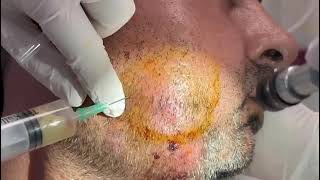 Odontogenic infections abscess [upl. by Gaves850]