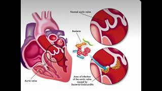 انتقال البكتيريا من السن الى القلب Infective endocarditis [upl. by Hubsher]