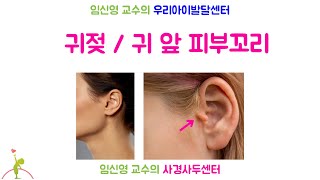 289 귀젖 귀 앞 피부꼬리 Preauricular Skin Tag [upl. by Ardnassak575]