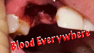 Tooth Removal  Two Teeth Get Removed  youtubeshorts shorts trending [upl. by Senskell]