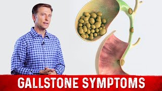 Gallstone Symptoms and Causes Explained – DrBerg on Gallbladder Stone Removal [upl. by Luas]