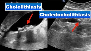 Cholelithiasis and choledocholithiasis I Ultrasound [upl. by Olotrab]