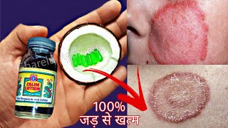 दाद खाज खुजली कि सिर्फ 2 दिन में छुट्टी कर देगा  fungal infection treatment  dad khaj khujli ilaj [upl. by Martinez29]