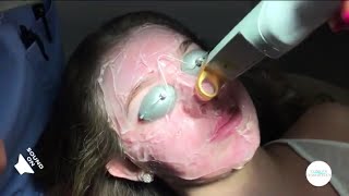 Acne Redness and Telangiectasia Caused By Acne Excel V Laser Treatment with Full Explanation [upl. by Adnorahs]