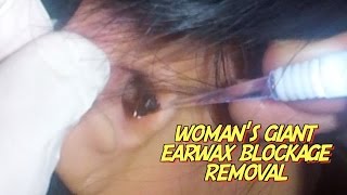 Womans Giant Earwax Blockage Removal [upl. by Nohpets760]